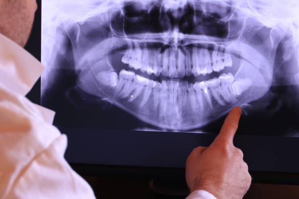 Best Emergency Wisdom Teeth Removal in Souderton, PA